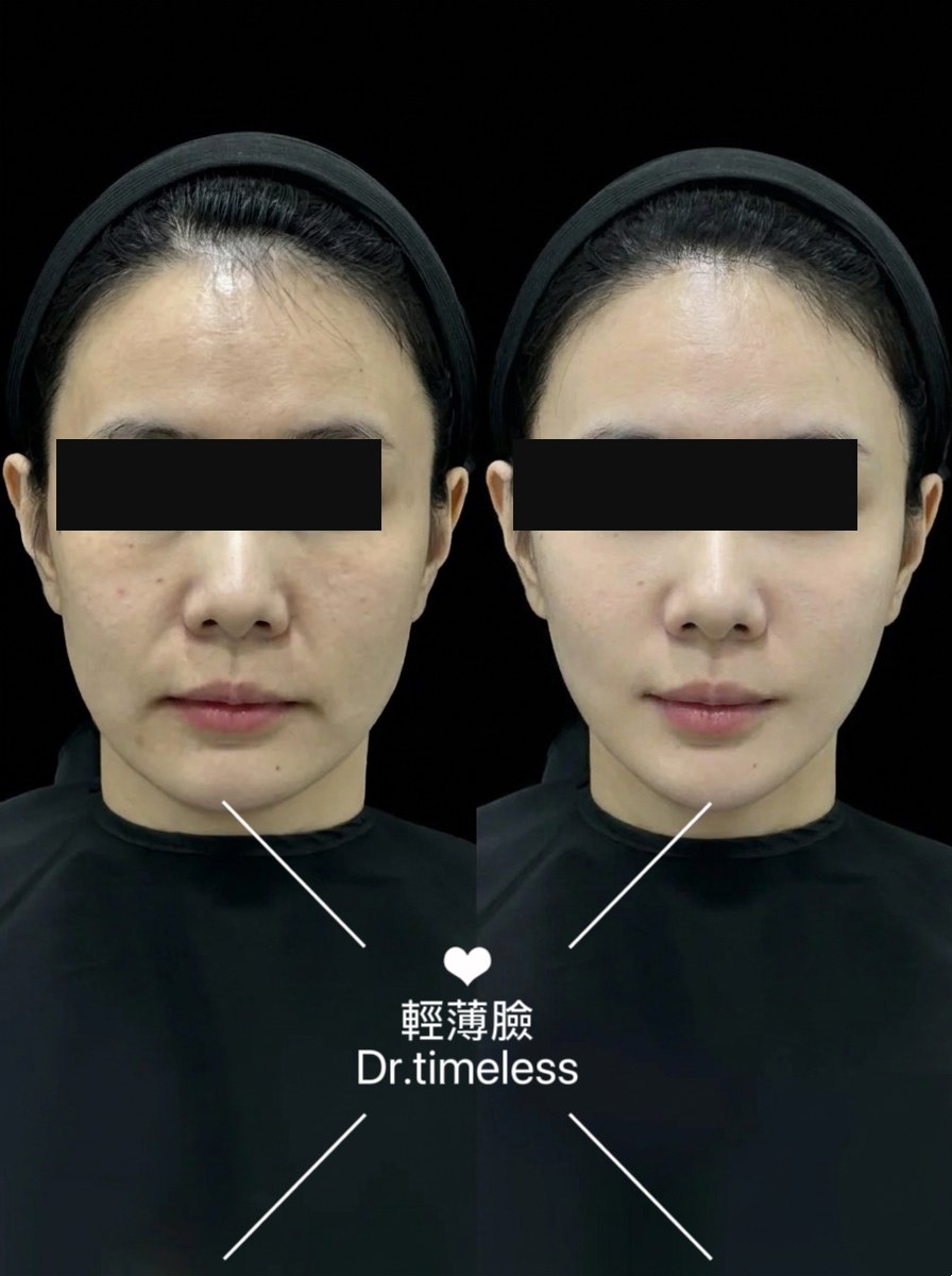 骨相重塑・輕薄臉 個案一 · 療程前後（眼部已遮蔽）
