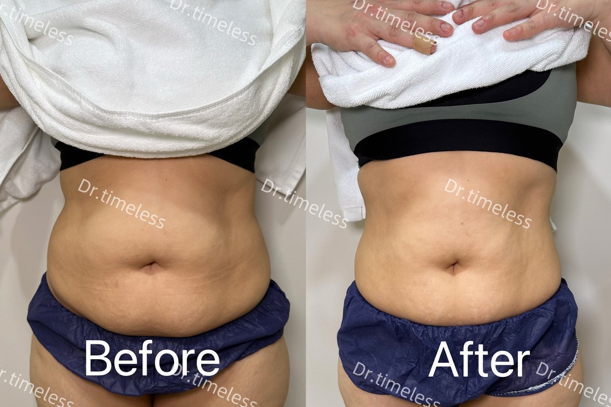 Onda Plus body 腹部 before after 實際案例 · Dr Timeless